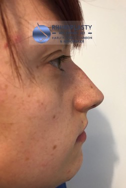 Rhinoplasty Harley Street | Before and After Gallery gallery image 7