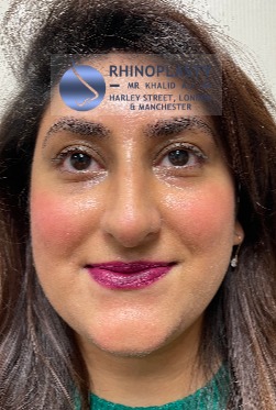 Rhinoplasty Harley Street | Before and After Gallery gallery image 28