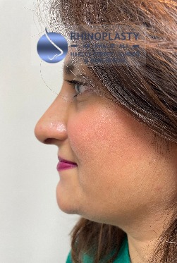 Rhinoplasty Harley Street | Before and After Gallery gallery image 24