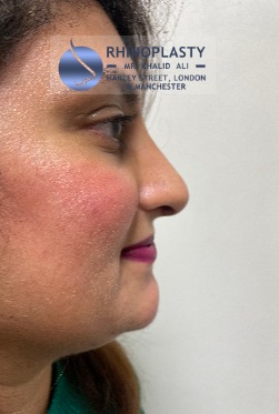 Rhinoplasty Harley Street | Before and After Gallery gallery image 26