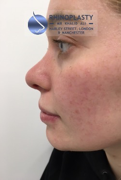 Rhinoplasty Harley Street | Before and After Gallery gallery image 38