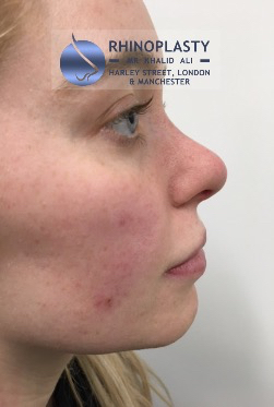 Rhinoplasty Harley Street | Before and After Gallery gallery image 40