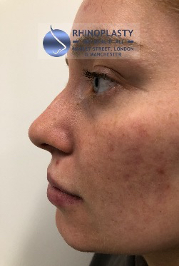Rhinoplasty Harley Street | Before and After Gallery gallery image 37