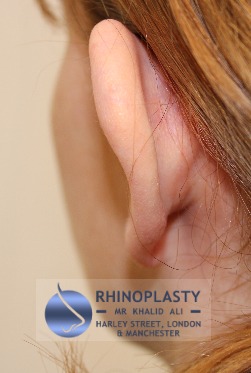 Rhinoplasty Harley Street | Before and After Gallery gallery image 1
