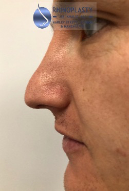 Rhinoplasty Harley Street | Before and After Gallery gallery image 61