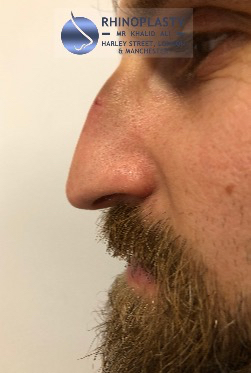 Rhinoplasty Harley Street | Before and After Gallery gallery image 57