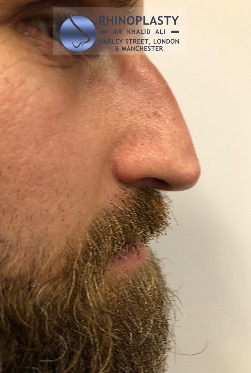 Rhinoplasty Harley Street | Before and After Gallery gallery image 59