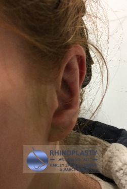 Rhinoplasty Harley Street | Before and After Gallery gallery image 6