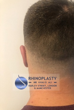 Rhinoplasty Harley Street | Before and After Gallery gallery image 12