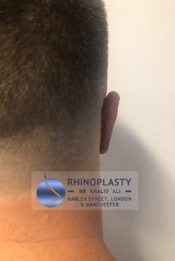 Rhinoplasty Harley Street | Before and After Gallery gallery image 10