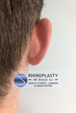 Rhinoplasty Harley Street | Before and After Gallery gallery image 15