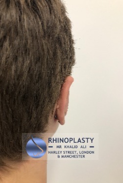 Rhinoplasty Harley Street | Before and After Gallery gallery image 16
