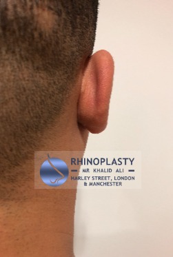 Rhinoplasty Harley Street | Before and After Gallery gallery image 27