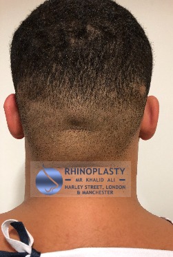 Rhinoplasty Harley Street | Before and After Gallery gallery image 25