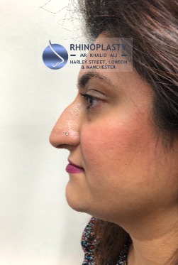 Rhinoplasty Harley Street | Before and After Gallery gallery image 23