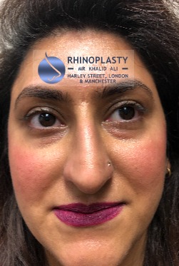 Rhinoplasty Harley Street | Before and After Gallery gallery image 27