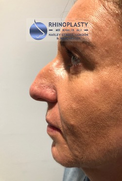 Rhinoplasty Harley Street | Before and After Gallery gallery image 29