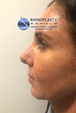 Rhinoplasty Harley Street | Before and After Gallery gallery image 30