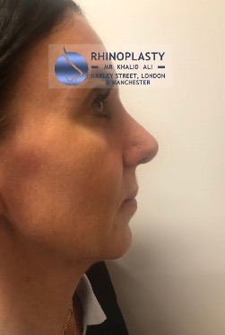 Rhinoplasty Harley Street | Before and After Gallery gallery image 32
