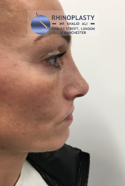 Rhinoplasty Harley Street | Before and After Gallery gallery image 4