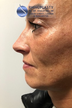 Rhinoplasty Harley Street | Before and After Gallery gallery image 1