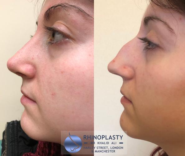 In this blog I will be detailing case studies of particularly successful Rhinoplasty, Otoplasty and other Facial Plastics procedures to explain how great a difference it can make on one's life both aesthetically and functionally.