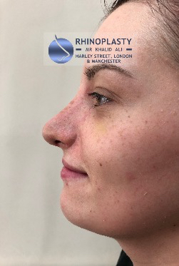 Rhinoplasty Harley Street | Before and After Gallery gallery image 6