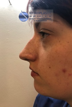 Rhinoplasty Harley Street | Before and After Gallery gallery image 5