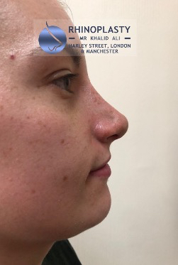 Rhinoplasty Harley Street | Before and After Gallery gallery image 8