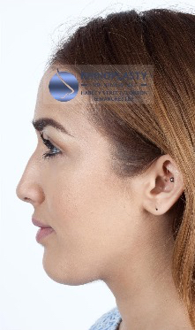 Rhinoplasty Harley Street | Before and After Gallery gallery image 53