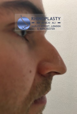 Rhinoplasty Harley Street | Before and After Gallery gallery image 43