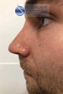 Rhinoplasty Harley Street | Before and After Gallery gallery image 42