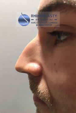 Rhinoplasty Harley Street | Before and After Gallery gallery image 41