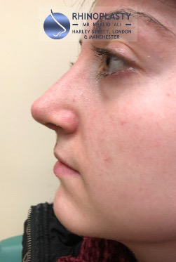 Rhinoplasty Harley Street | Before and After Gallery gallery image 34