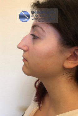 Rhinoplasty Harley Street | Before and After Gallery gallery image 33