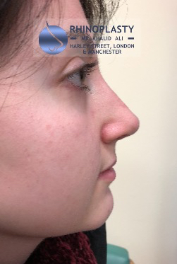Rhinoplasty Harley Street | Before and After Gallery gallery image 36