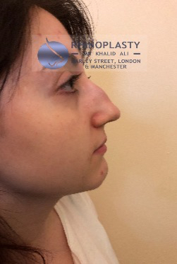 Rhinoplasty Harley Street | Before and After Gallery gallery image 35