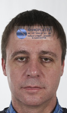 Rhinoplasty Harley Street | Before and After Gallery gallery image 72