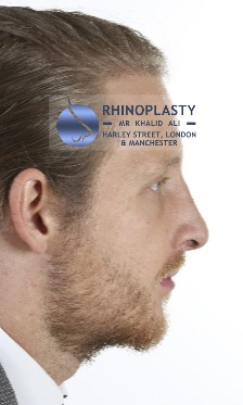 Rhinoplasty Harley Street | Before and After Gallery gallery image 68