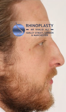 Rhinoplasty Harley Street | Before and After Gallery gallery image 67