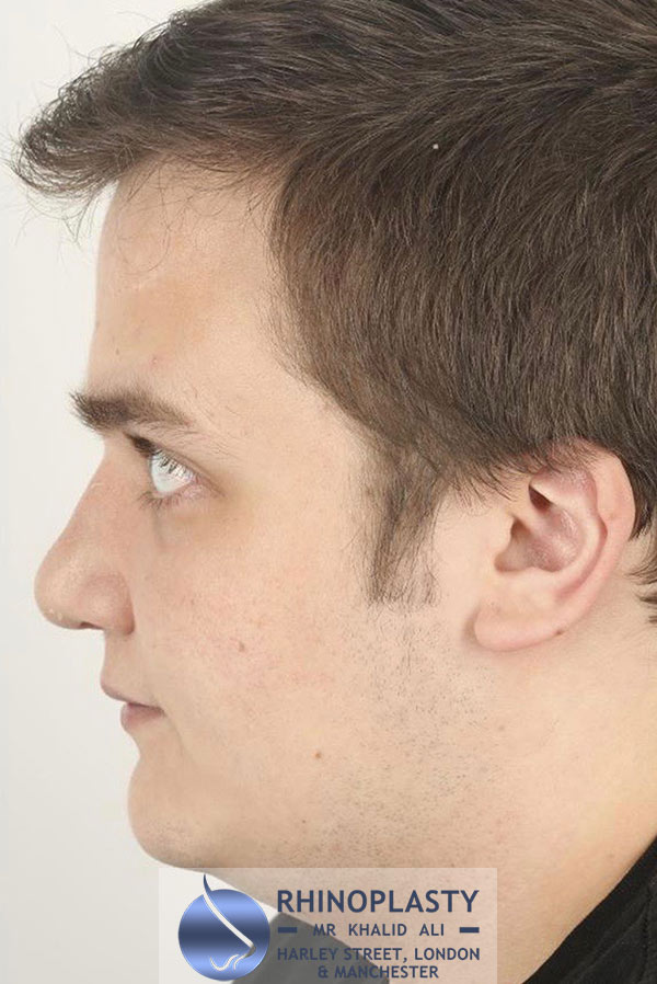 Rhinoplasty Harley Street | Before and After Gallery gallery image 50