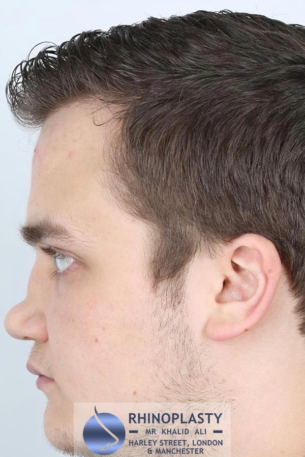 Rhinoplasty Harley Street | Before and After Gallery gallery image 49