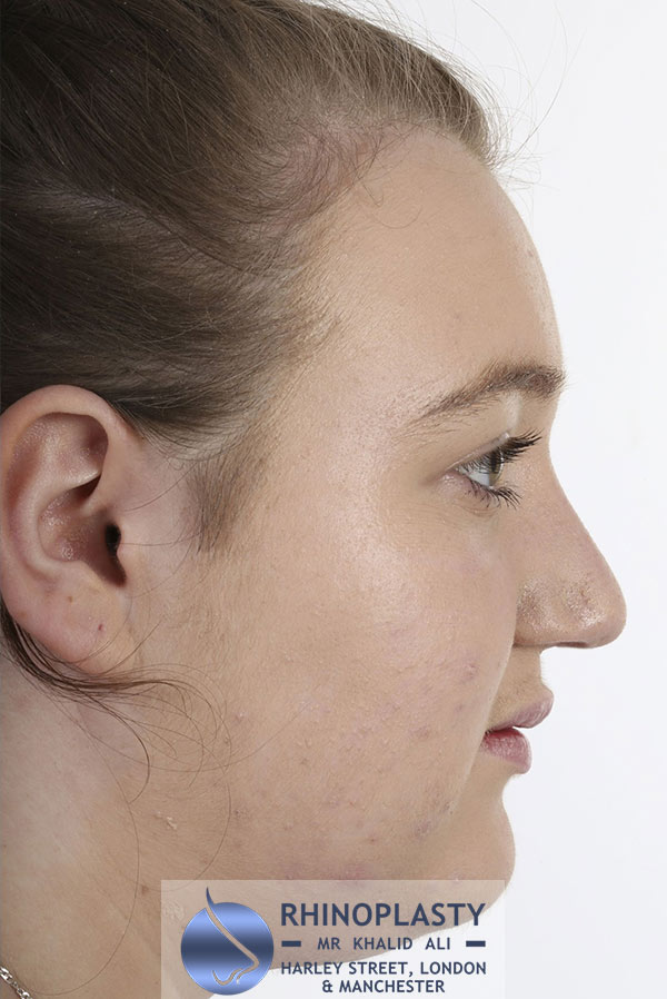 Rhinoplasty Harley Street | Before and After Gallery gallery image 48