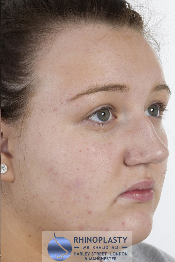 Rhinoplasty Harley Street | Before and After Gallery gallery image 45
