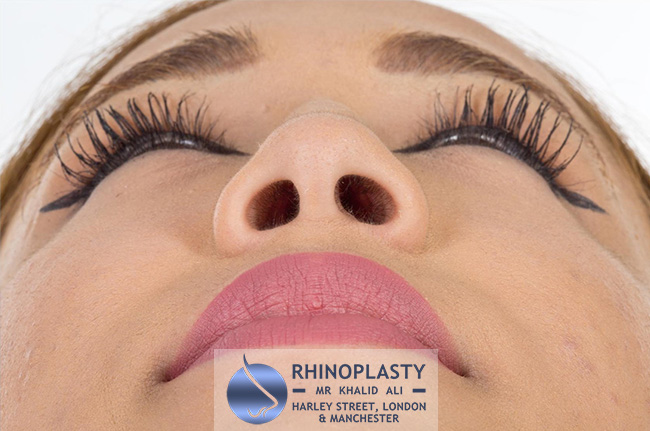 Rhinoplasty Harley Street | Before and After Gallery gallery image 74