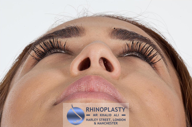 Rhinoplasty Harley Street | Before and After Gallery gallery image 73