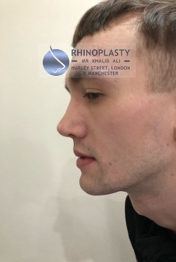 Rhinoplasty Harley Street | Before and After Gallery gallery image 18