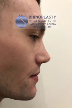 Rhinoplasty Harley Street | Before and After Gallery gallery image 20