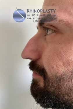 Rhinoplasty Harley Street | Before and After Gallery gallery image 9