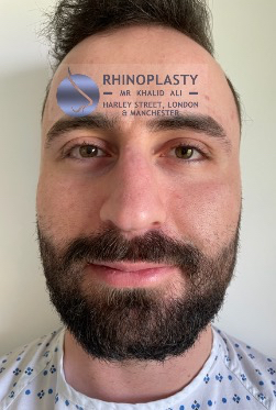 Rhinoplasty Harley Street | Before and After Gallery gallery image 13